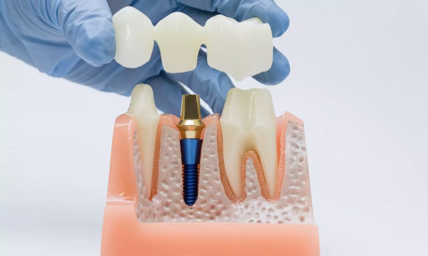 3D-Printed Zirconia Crowns Could Be Ready While You Wait