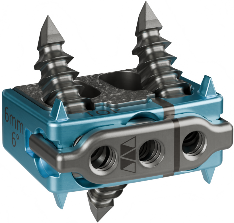 Elevation Spine Wins FDA Clearance for 3D-Printed Titanium Cervical Implant