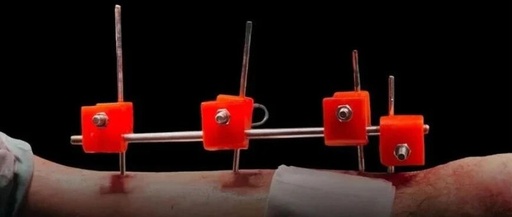 Doctors in Gaza Use 3D Printing to Build Life-Saving Orthopedic Fixators
