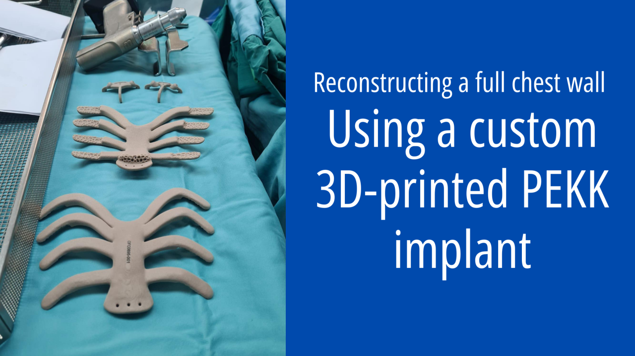 Israeli Surgeons Replace Chest Wall With 3D-Printed PEKK Rib Cage