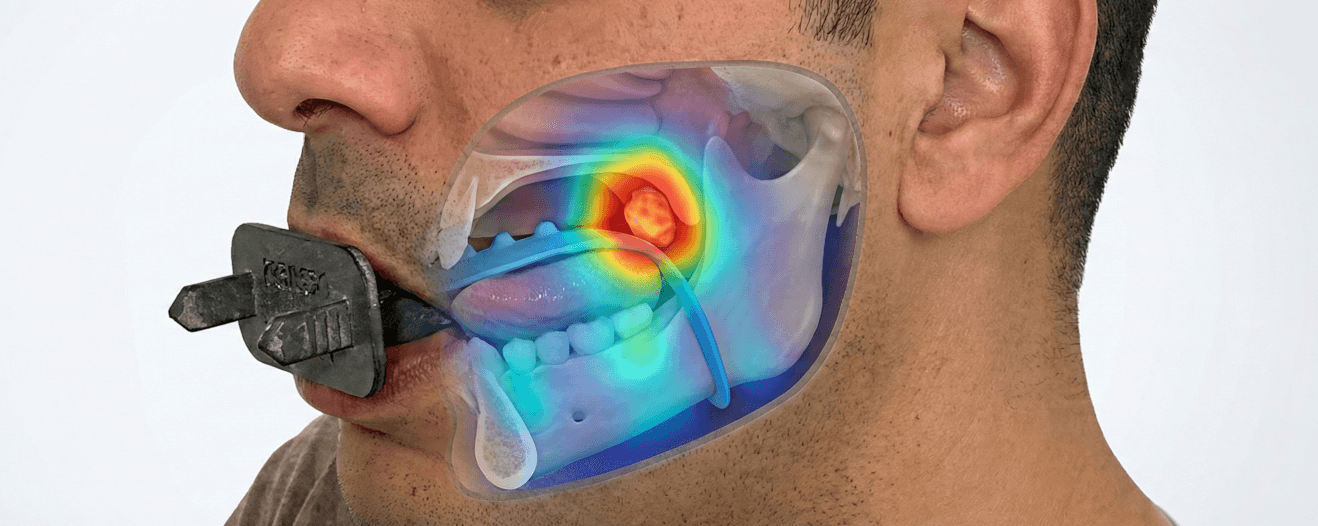 Texas Cancer Institute Adopts Kallisio 3D-Printed Oral Stent for Head and Neck Radiation