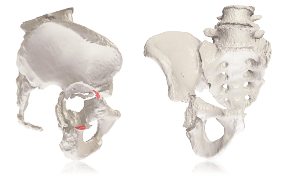 Onkos Surgical Reaches 1,000th 3D Printed Pelvic Implant Case