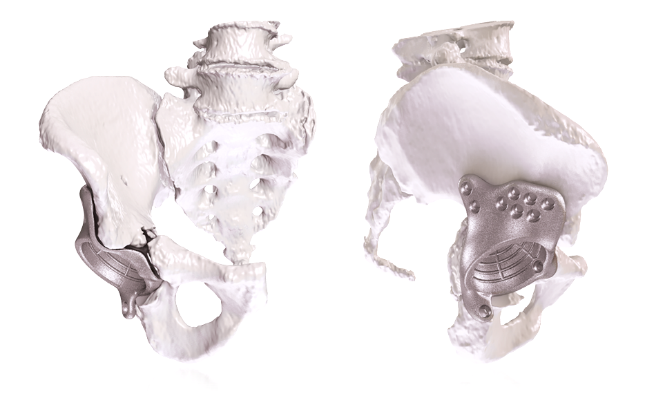 Onkos Surgical Reaches 1,000 3D-Printed Pelvic Implant Cases
