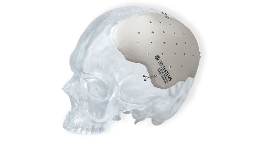 Walter Reed Receives FDA Clearance for 3D-Printed Titanium Cranial Implants